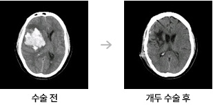 [신경외과분야] 고혈압성 뇌출혈 관련이미지
