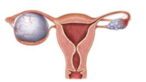 난소 낭종(ovarian cysts) 관련이미지