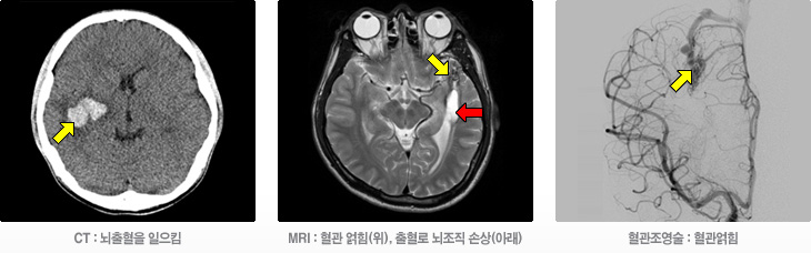 [신경외과분야] 뇌동정맥기형
