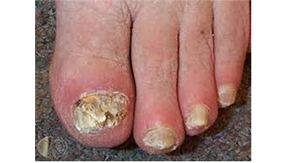 손발톱진균증(Onychomycosis) 관련이미지