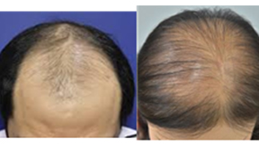 안드로겐탈모(Androgenetic alopecia) 관련이미지