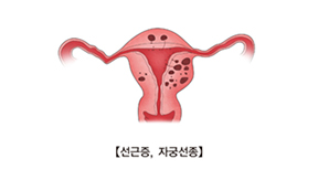 자궁선근증(Adenomyosis) 관련이미지