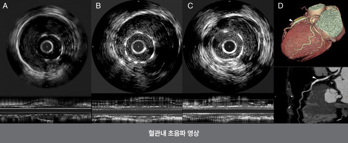 [심장혈관검사] 심혈관정밀검사 관련이미지