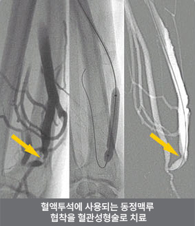 [심장혈관검사]말초혈관성형술 관련이미지